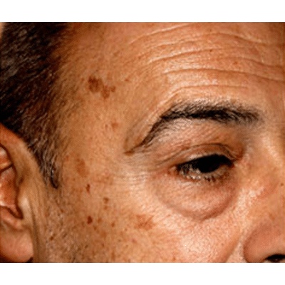 Brown Pigment, Age Spots, Melasma (Professionals Only) - Julia T Hunter MD